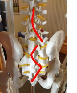 腰椎と仙骨の変位